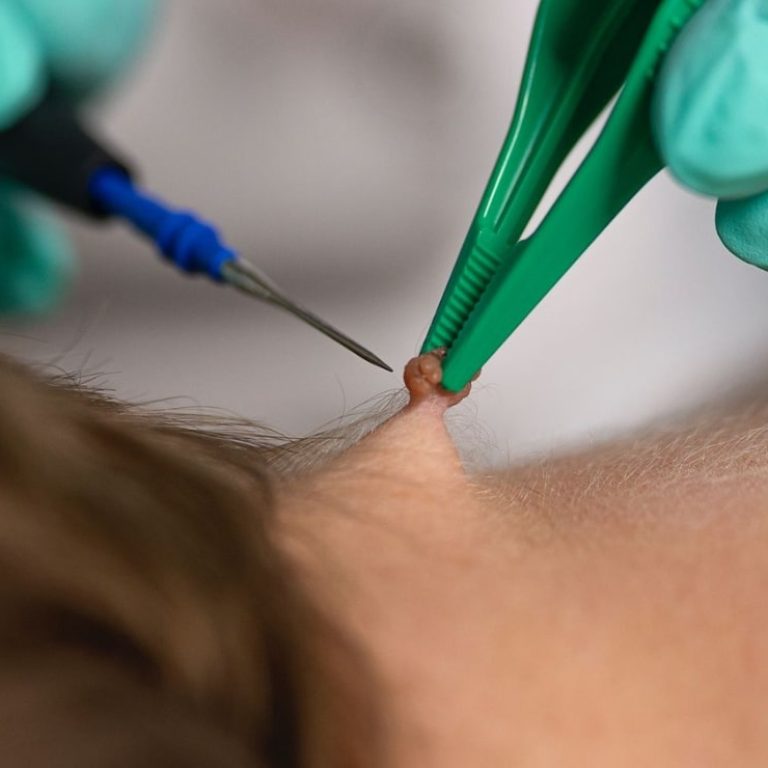 Laseroterapia (2)-min