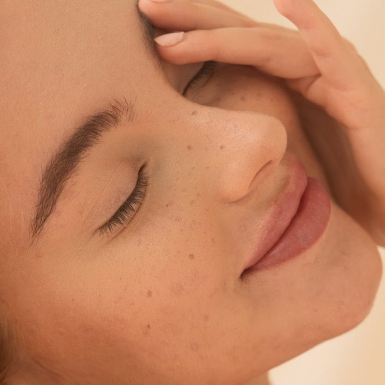 Terapia Fotobiodynamiczna - Redness -min